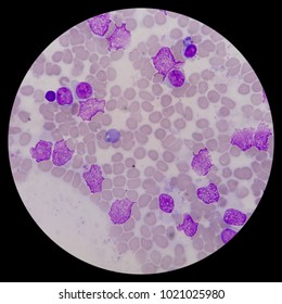 Microscopic Zoom. Bone Marrow Aspiration Smear From Relapsed Acute Myeloid Leukemia (AML) Pediatric Patient. Smear Shows Myeloblast, Platelets, And Erythroblast.