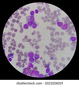 Microscopic Zoom. Bone Marrow Aspiration Smear From Relapsed Acute Myeloid Leukemia (AML) Pediatric Patient. Smear Shows Myeloblast, Platelets, And Erythroblast.