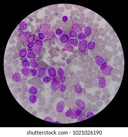 Microscopic Zoom. Bone Marrow Aspiration Smear From Relapsed Acute Myeloid Leukemia (AML) Pediatric Patient. Smear Shows Myeloblast, Platelets, And Erythroblast.