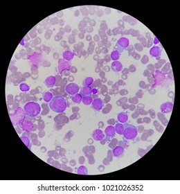 Microscopic Zoom. Bone Marrow Aspiration Smear From Relapsed Acute Myeloid Leukemia (AML) Pediatric Patient. Smear Shows Myeloblast, Platelets, And Erythroblast.