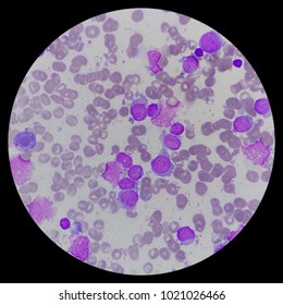 Microscopic Zoom. Bone Marrow Aspiration Smear From Relapsed Acute Myeloid Leukemia (AML) Pediatric Patient. Smear Shows Myeloblast, Platelets, And Erythroblast.