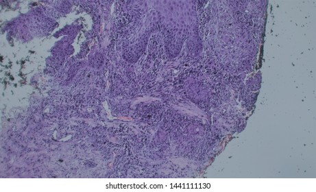 Microscopy Of Cytopathology Slides And Histopathology. Slides Of Cytopathology.