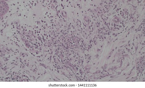 Microscopy Of Cytopathology Slides And Histopathology. Slides Of Cytopathology.