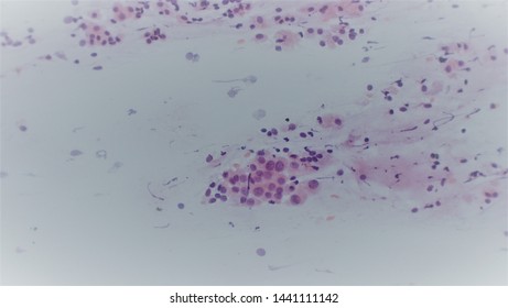 Microscopy Of Cytopathology Slides And Histopathology. Slides Of Cytopathology.