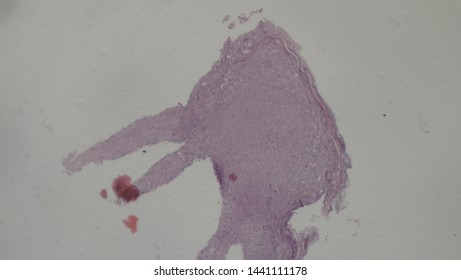 Microscopy Of Cytopathology Slides And Histopathology. Slides Of Cytopathology.