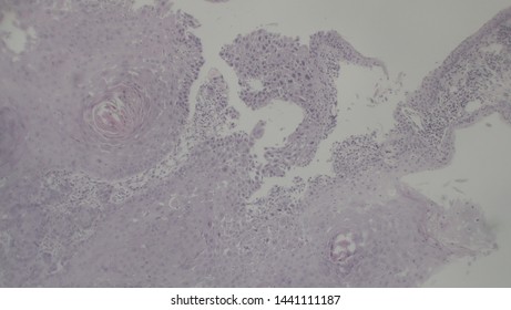 Microscopy Of Cytopathology Slides And Histopathology. Slides Of Cytopathology.