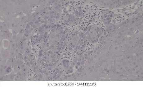 Microscopy Of Cytopathology Slides And Histopathology. Slides Of Cytopathology.