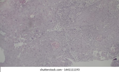 Microscopy Of Cytopathology Slides And Histopathology. Slides Of Cytopathology.