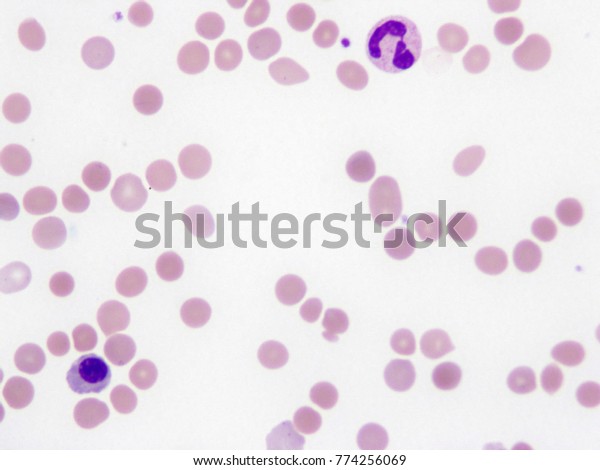 Microspherocytes On Peripheral Blood Smear Autoimmune Stock Photo