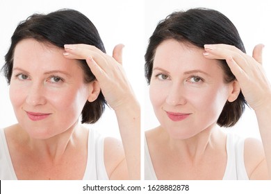 Middle Age Close Up Forehead Woman Happy Face Before After Cosmetic Procedures. Skin Care For Wrinkled Face. Before-after Anti-aging Facelift Treatment. Facial Skincare, Contouring. Beauty And Make-up