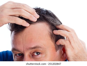 Middle Age Man Suffering From Androgenic Hair Loss.