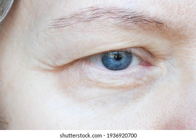 middle aged female's eye with drooping eyelid. Ptosis is a drooping of the upper eyelid, lazy eye. Cosmetology and facial concept, first wrinkles, closeup