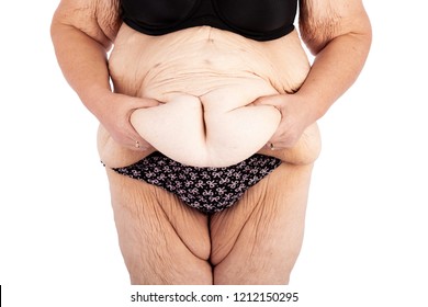 Middle aged woman with sagging skin after babies and extreme weight loss. Inspiration for poster and meme, before brachioplasty, panniculectomy, abdominoplasty and mummy makeover in Australia.