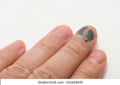 Bruised Nail Images Stock Photos Vectors Shutterstock