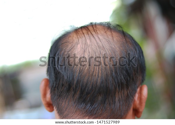 Middleaged Man Bald Head Thin Hair Stock Photo Edit Now 1471527989