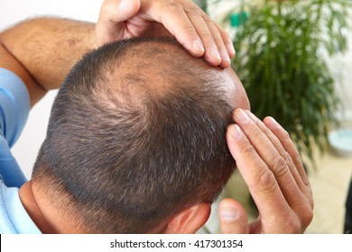 Mann mittleren Alters besorgt über Haarausfall. Leidenschaft