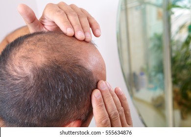 Mann mittleren Alters, der sich um Haarausfall kümmert. Leidenschaft
