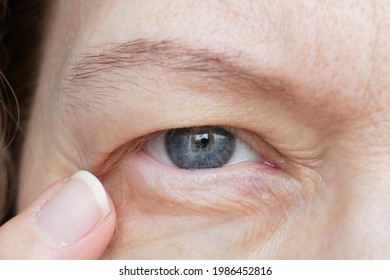 middle-aged woman does corrective eye makeup to correct the drooping eyelid. Ptosis is a drooping of the upper eyelid, lazy eye. Cosmetology and facial concept, closeup