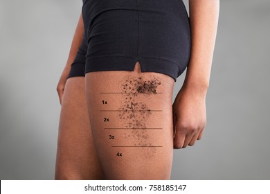 Midsection View Of A Laser Tattoo Removal On Woman's Thigh