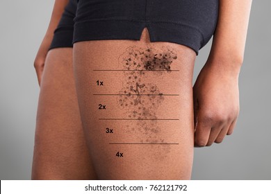 Midsection View Of A Laser Tattoo Removal On Woman's Thigh