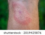 migrating erythema after a tick bite on a man