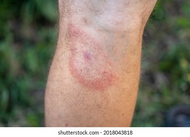 migrating erythema after a tick bite on a man's leg. a symptom of tick-borne borreliosis. a red ring in the form of a target on the leg