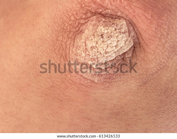 Mild Case Psoriasis Vulgaris Psoriatic Skin Stock Photo Edit Now