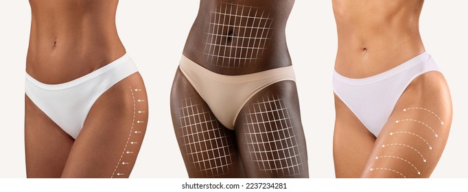 Millennial diverse females in bikini with perfect skin, lines for body shaping or drainage massage and laser therapy isolated on white background, studio. Contouring plastic surgery and fit results - Shutterstock ID 2237234281