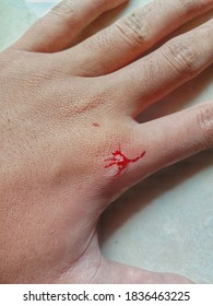 Minor Injury To The Hand