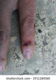 Minor Wounds To The Fingers Generally Heal On Their Own With Good Wound Care