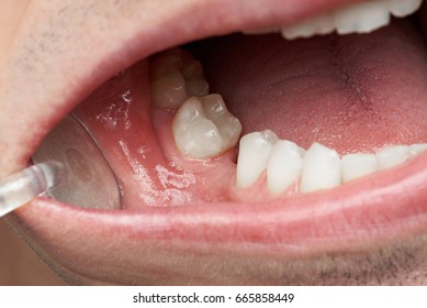 Missing Tooth In Man Mouth Close-up. Dentist Checking Missing Teeth