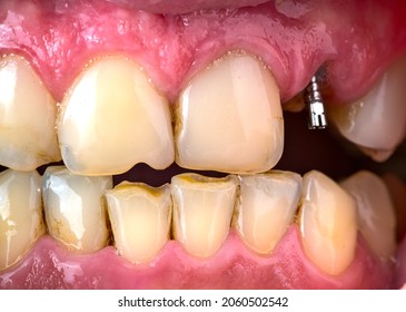 A Missing Tooth And A Stent Screwed Into Its Place In Closeup.