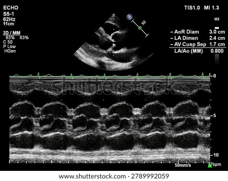 M-mode Echocardiogram of Left Atrium and Aortic Root — Cardiac Ultrasound Showing LA and Aorta Dimensions for Heart Chamber Size Assessment