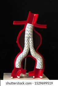 Model Of Aortic Aneurysm That Has Treatment By Endovascular Fenestrated And Branched Stent Grafts. Endovascular Aortic Aneurysm Repair (EVAR)