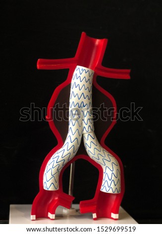 Model of aortic aneurysm that has treatment by endovascular fenestrated and branched stent grafts. Endovascular aortic aneurysm repair (EVAR)