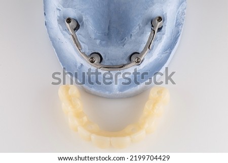 a model with a bar and a temporary prosthesis for immediate loading after implantation, top view on a white background