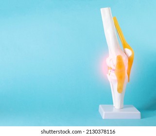 Model Of A Human Knee Joint On A Blue Background. Inflamed Knee Treatment, Pain. Copy Space For Text, Close-up