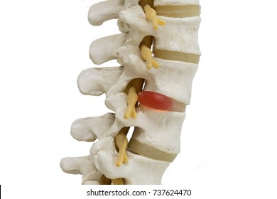 Model Of Human Lumbar Spine Demonstrating Herniated Disc