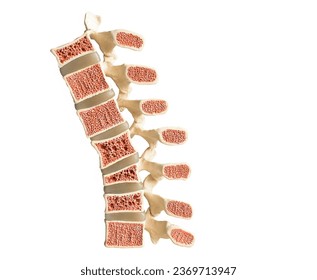 Model of the human spine isolated on a white background showing various defects in the bones and vertebrae. From bottom to top: normal vertebral bone, compression fracture, wedge fracture, osteoporose