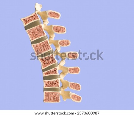 Model of the human spine isolated on a blue background showing various defects in the bones and vertebrae. From bottom to top: normal vertebral bone, compression fracture, wedge fracture, osteoporotic