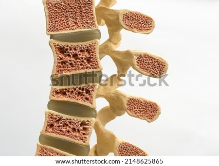 Model of the human spine on a white background, which shows various defects in bones and vertebrae. From top to bottom: normal vertebral bone, osteoporotic bone, wedge fracture, compression fracture.