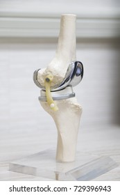 The Model Of Knee Joint After Total Knee Replacement Surgery.