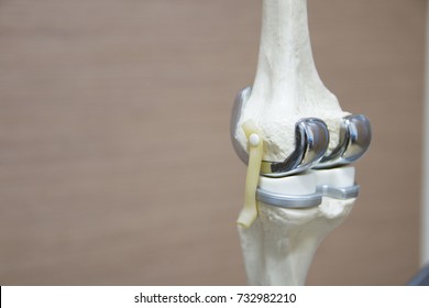 The Model Of Knee Joint After Total Knee Replacement Surgery.