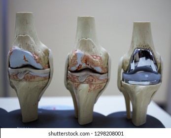 model of knee joint showing multiple stages of knee osteoarthritis and total knee replacement or arthroplasty. 