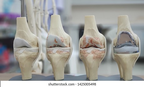 Model Of Knee Joint Showing Multiple Stages Of Knee Osteoarthritis(OA Knee) And Total Knee Replacement(TKR). Blurred Skeletal Model And Examination Room Background.