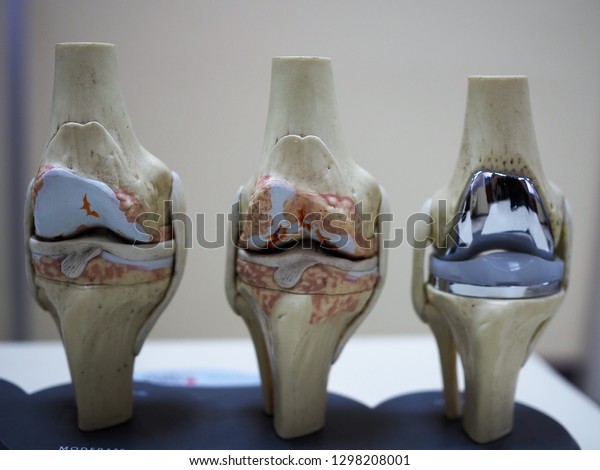 model of knee\
joint showing multiple stages of knee osteoarthritis and total knee\
replacement or arthroplasty.\
