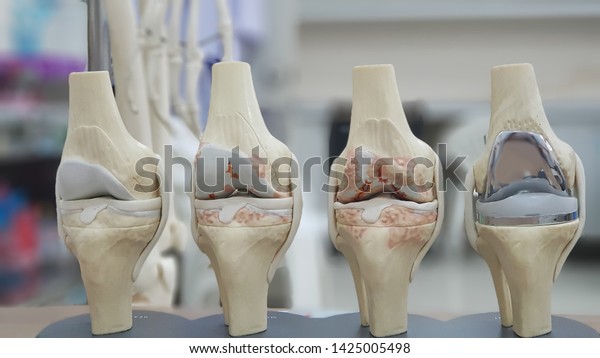Model of knee joint showing\
multiple stages of knee osteoarthritis(OA knee) and total knee\
replacement(TKR). Blurred skeletal model and examination room\
background.