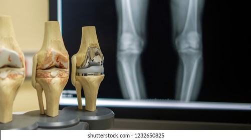 The model of knee joint shown the process of osteoarthritis of knee and total knee replacement surgery. Film both knee in AP on background