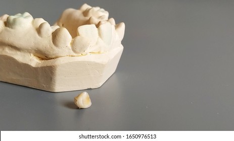 Model Of The Lower Human Jaw With Crooked Teeth, Sculpted By A Dentist From Plaster. A Small Milk Tooth Falling Out Of The Mouth Of A Preschool Child. Initial Caries Changes. Gray Background.