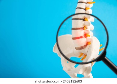 Model of the lumbar spine with a red intervertebral hernia and protrusion on a blue background under a magnifying glass. Concept of osteochodrosis and spondyloarthrosis and spinal arthritis. 